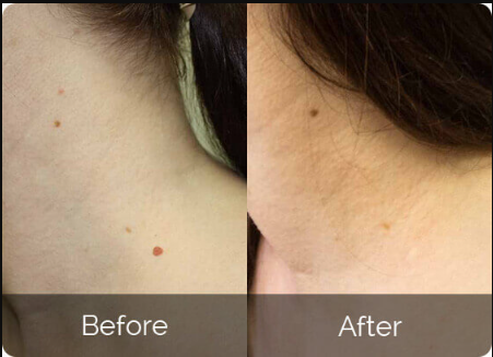 SkinBiotix MD Before & After Results