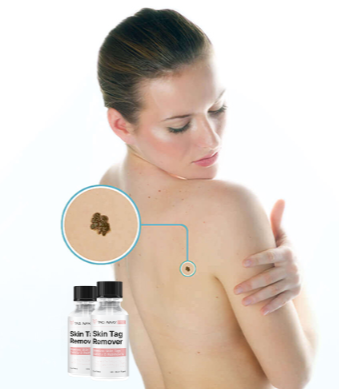 Tag Away Pro Skin Tag Benefits