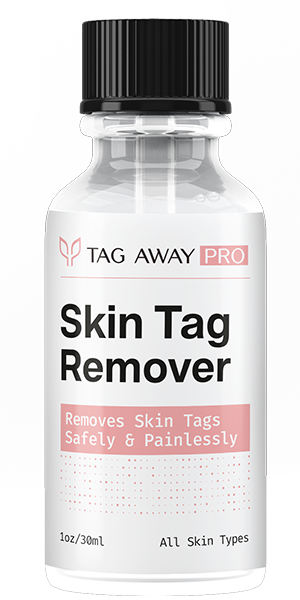 Tag Away Pro Skin Tag Reviews