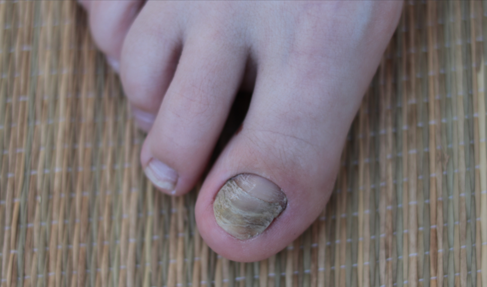 Does Crystal Flush Work For Toenail Fungus