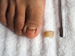 Iodine for toenail fungus