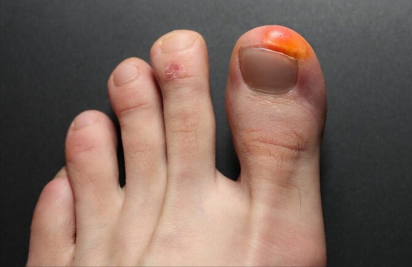 Nystatin for Toenail Fungus