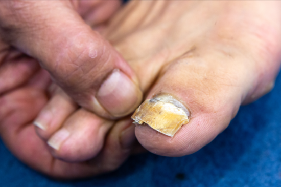 biblical cure for toenail fungus