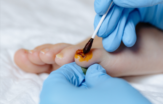 clove oil for toenail fungus