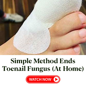 Toenail Fungus Treatment #2