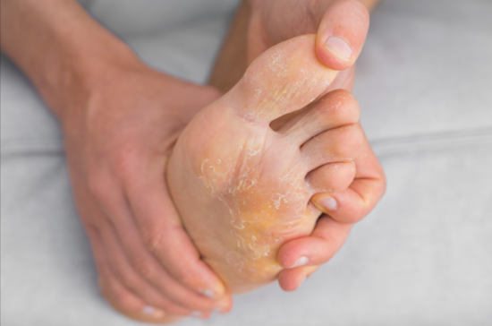 urea for toenail fungus