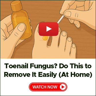 Toenail Fungus Do This to Remove it Easily at Home