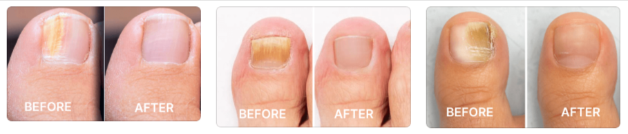 Blinzador Before - After