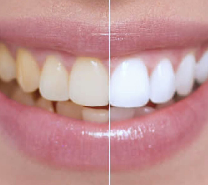WellaWhite Teeth Whitening Kit-Benefits