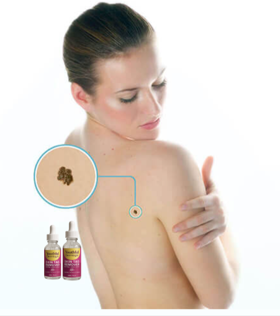 Youthful Dermlogix Skin Tag Remover Benefits
