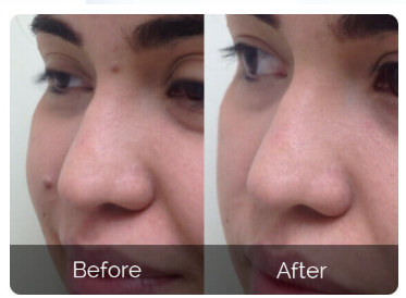 Youthful Dermlogix Skin Tag Remover Cus 1