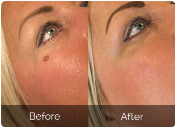 Youthful Dermlogix Skin Tag Remover Cus 2