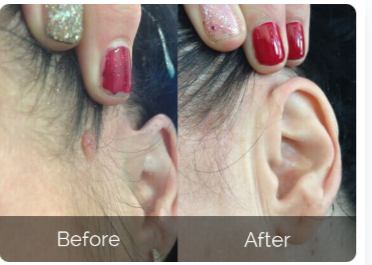 Youthful Dermlogix Skin Tag Remover Cus 3