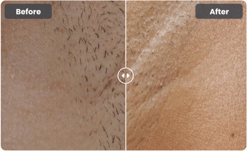 Glokore IPL Hair Remover-Benefits