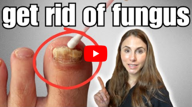 How to Get Rid of Severe Toenail Fungus