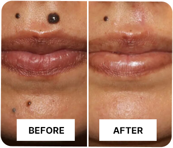 NutriDermaGuard Skin Tag Remover Benefits