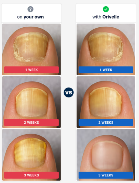 Orivelle-Anti-Fungal-Pen-benefits