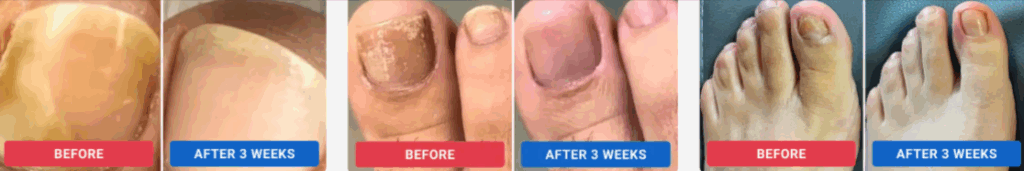 Orivelle-Anti-Fungal-Pen uses