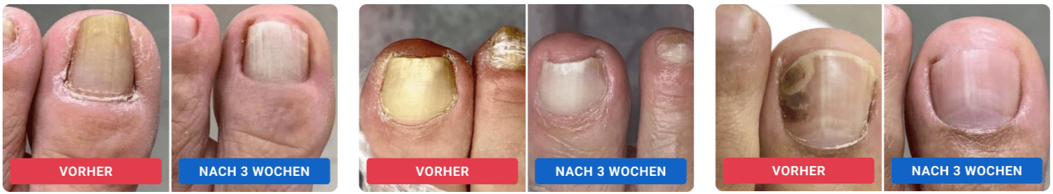 Orivelle Fungus Pen-benefits