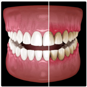 PearliPen Teeth Whitening-Benefits