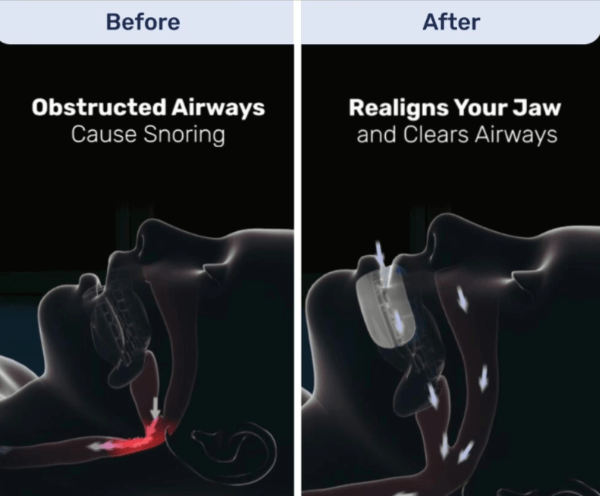 SleepZee Anti Snoring Mouthpiece benefits