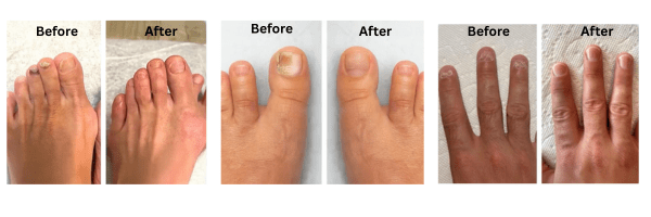 WellaNail Fungus Treatment - Results
