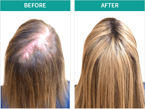 BioGrow Advanced Hair Regrowth benefits