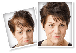 BioGrow Advanced Hair Regrowth cus 3