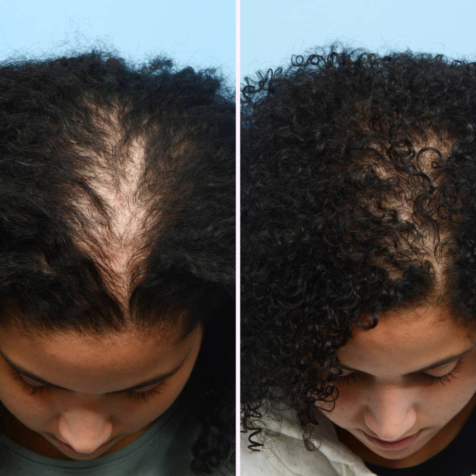 hair growth before after