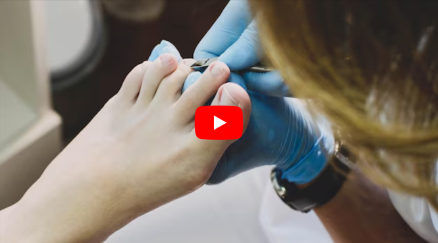 Jaysuing Nail Fungus video