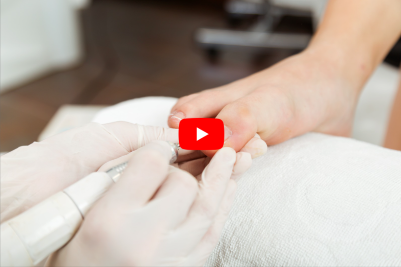 Nail Fungus Treatment video