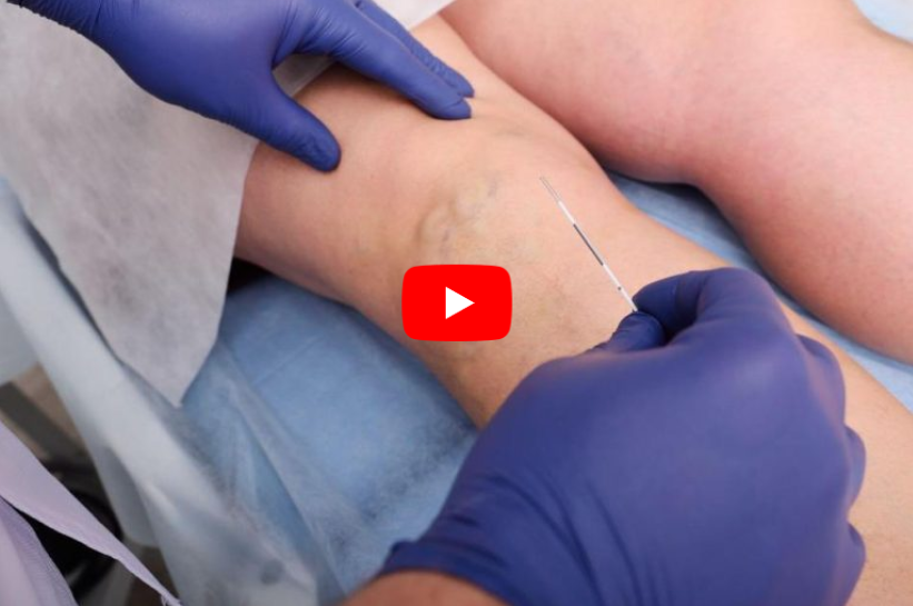Varicose Vein Injections Side Effects video