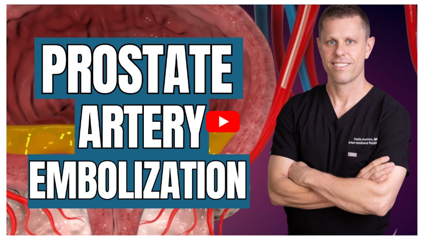 What Men Should Know About Prostate Artery Embolization