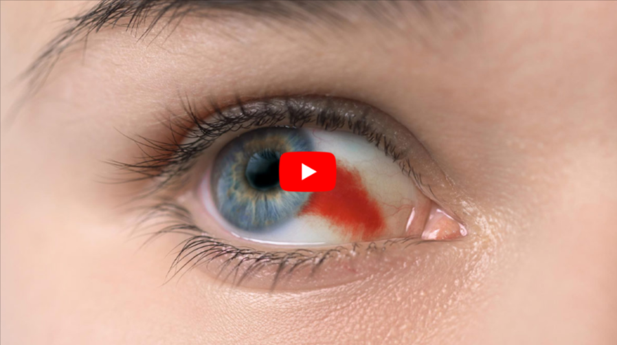 Why Is Your Eye Bloody video