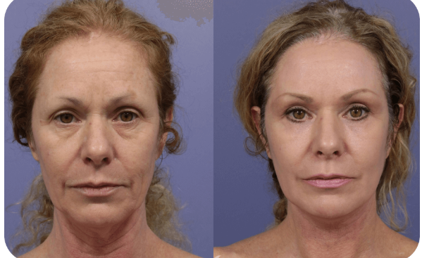 Synevra UltraLift Benefits