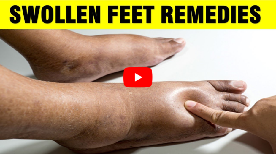 Edema in Feet and Ankles video