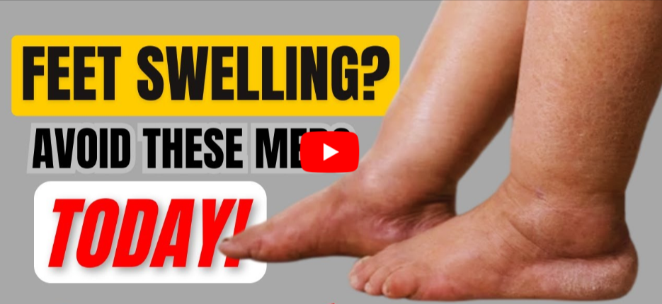 Edema in Legs and Feet video