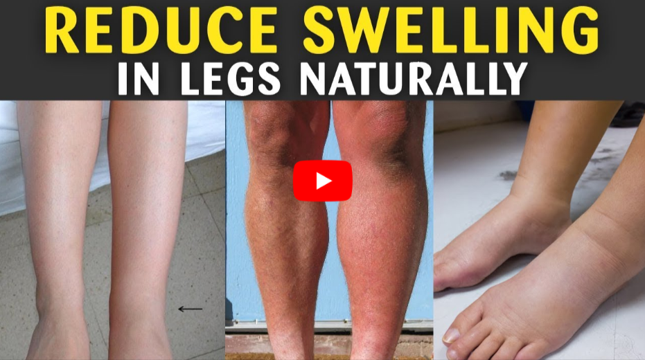 How to Treat Edema in Legs and Feet at Home Naturally video