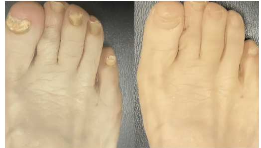 PODOclear LLLT Device Cus 3