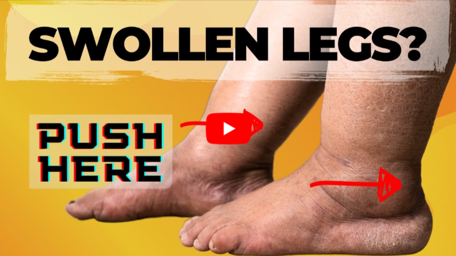 Reduce Foot and Ankle Swelling video