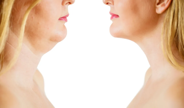 Berberine Plus before and after