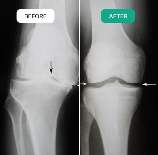 RejuvaKnee before and after