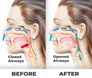 SnoreStop benefits