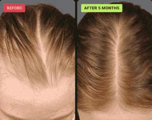 HaloGrow Hairspray results timeline