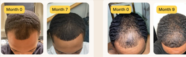 Keeps Hair Loss customer reviews