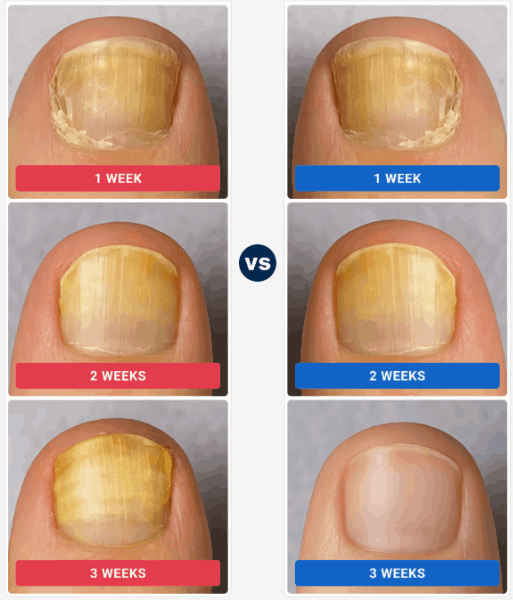 Orivelle Fungus Pen week by week