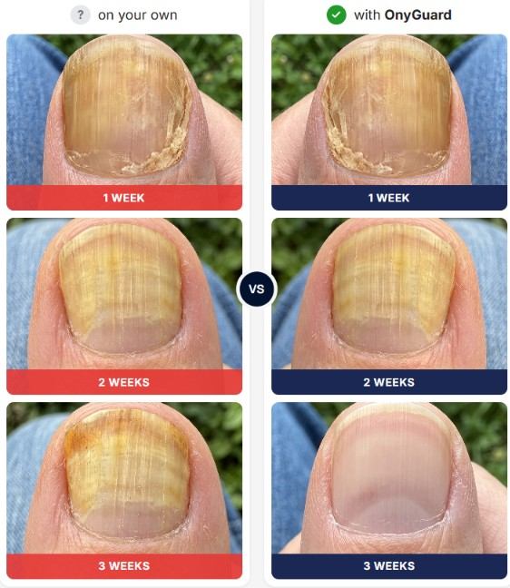 OnyGuard Anti-Fungal Pen Week By Week